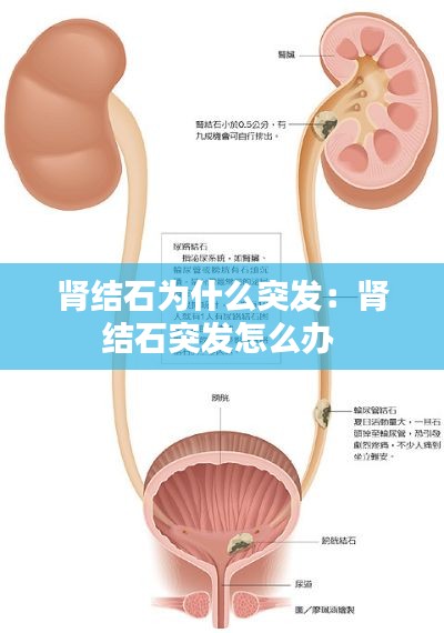 肾结石为什么突发：肾结石突发怎么办 