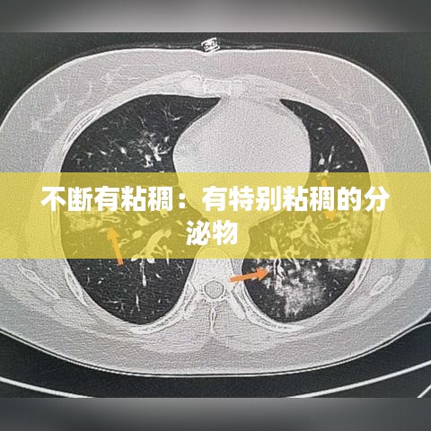 不断有粘稠：有特别粘稠的分泌物 