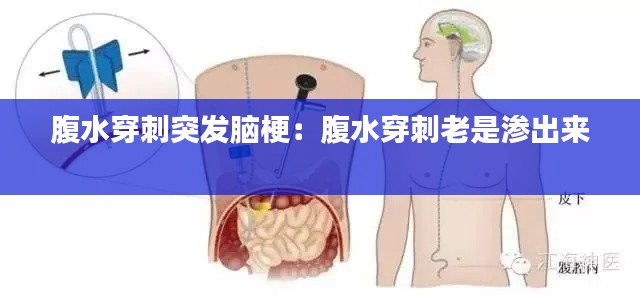 腹水穿刺突发脑梗：腹水穿刺老是渗出来 