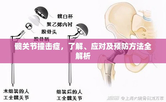 髋关节撞击症，了解、应对及预防方法全解析